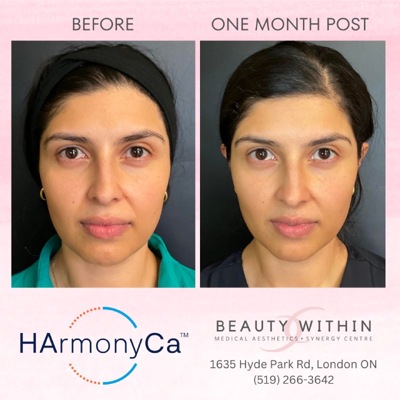 HArmonyCa treatment 1