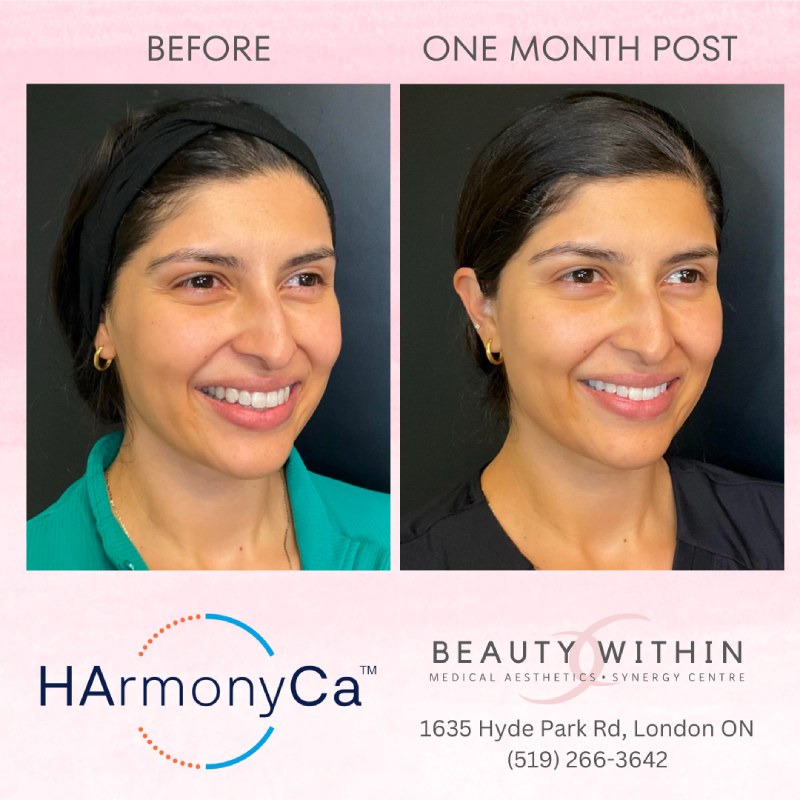 HArmonyCa treatment 2