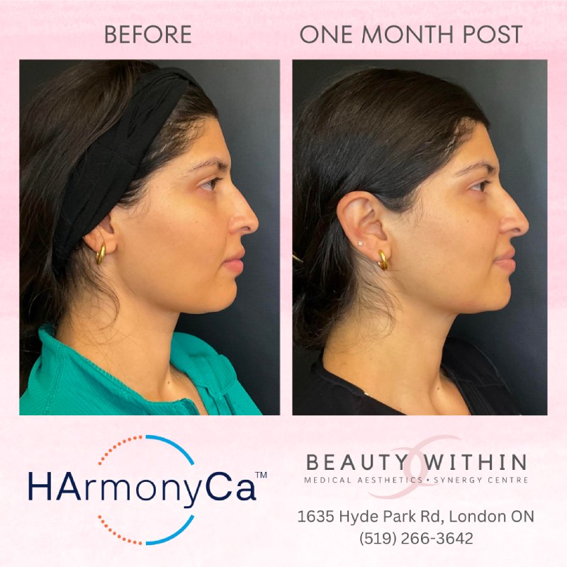 HArmonyCa treatment 3