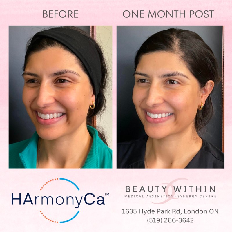 HArmonyCa treatment 4
