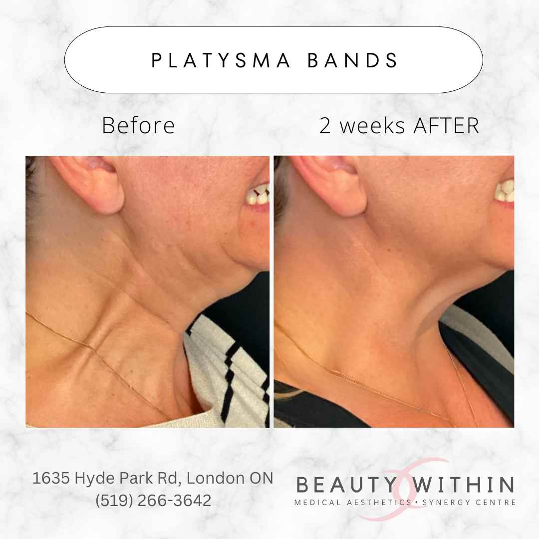 Botox relaxes the neck's platysma muscle