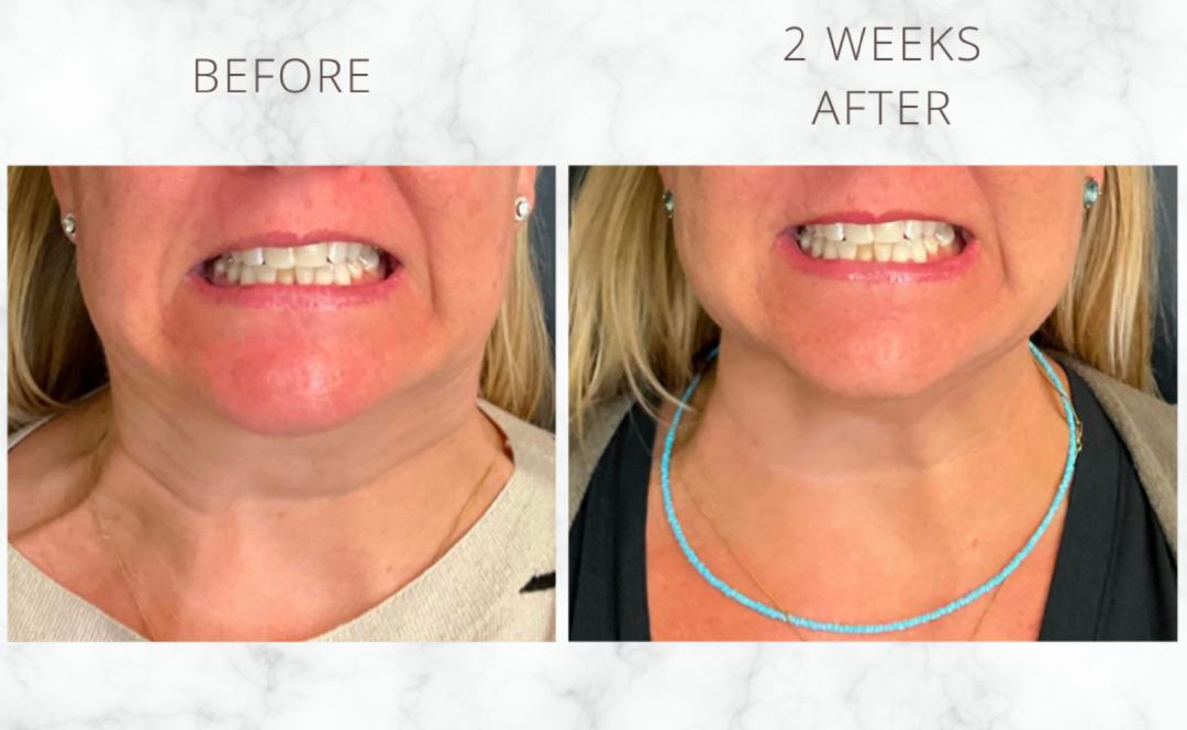 Botox injections for neck bands