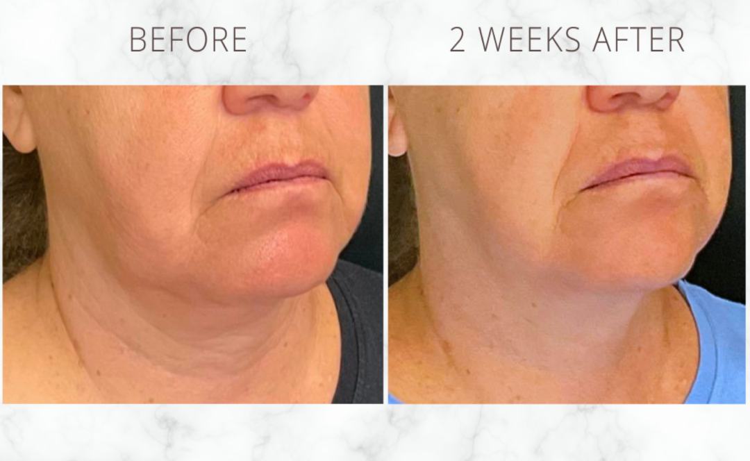 Botox treatment along the jawline and neck
