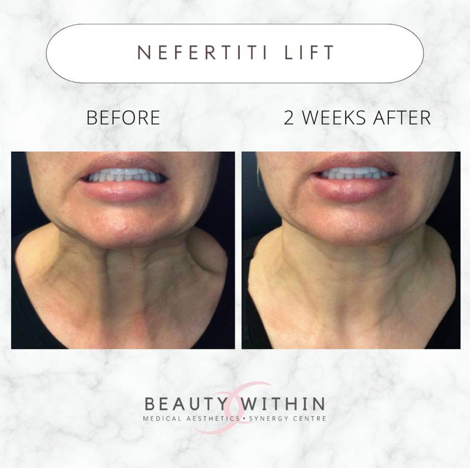 Botox relaxes the neck's platysma muscle